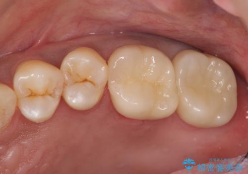 段差の気になる銀歯を改善したいの治療後