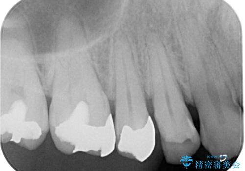 銀歯がとれた!セラミックインレーによる修復の治療前