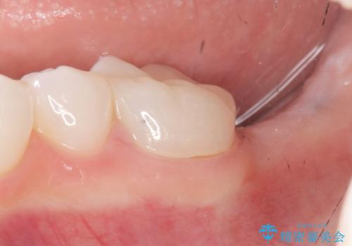[ インプラント治療 ]  失った歯の咬合機能回復の症例 治療前