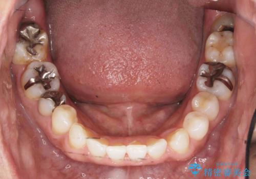 銀歯だらけの口の中を改善したいの治療前