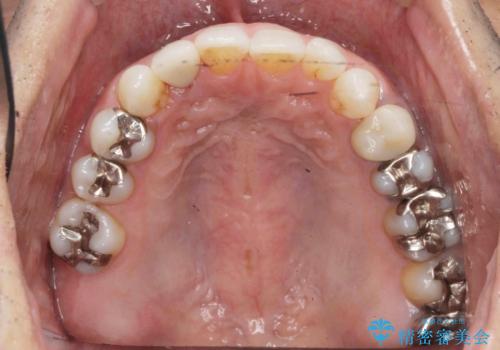 銀歯だらけの口の中を改善したいの症例 治療前