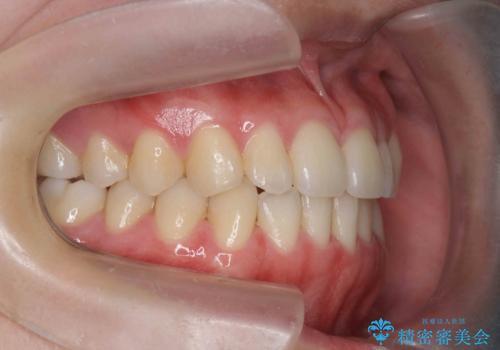 マウスピース矯正で前歯のガタつきを改善の治療後