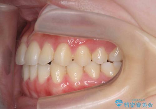 マウスピース矯正で前歯のガタつきを改善の治療後