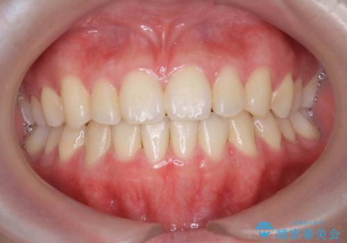マウスピース矯正で前歯のガタつきを改善の症例 治療後