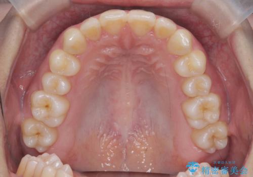 マウスピース矯正で前歯のガタつきを改善の治療後