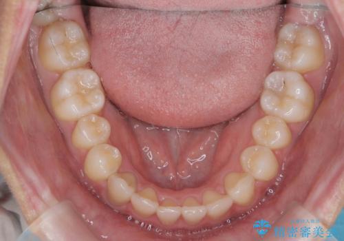 マウスピース矯正で前歯のガタつきを改善の治療後