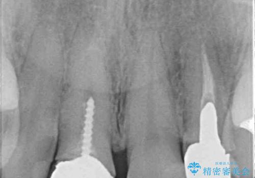 変色した保険クラウンをきれいに オールセラミッククラウンによる補綴治療の治療前