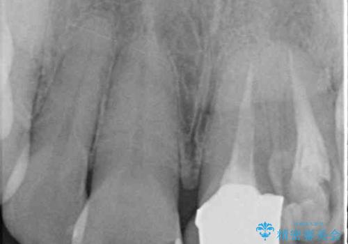 横から見た時の歯の色が違いすぎる 前歯のオールセラミッククラウンの治療前