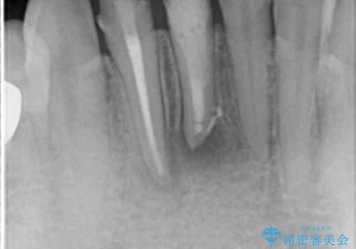 [ 歯ぐきを押すと痛む ]　根管治療の必要な前歯治療の治療中