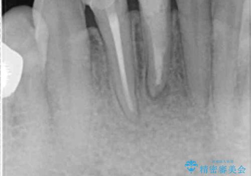 [ 歯ぐきを押すと痛む ]　根管治療の必要な前歯治療の治療後