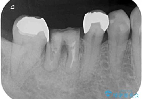 インプラントしかないと言われた 奥歯のオールセラミックブリッジの治療前