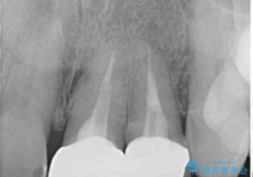横から見た時の歯の色が違いすぎる 前歯のオールセラミッククラウンの治療後