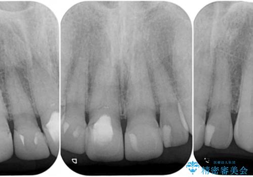 テトラサイクリン歯をオールセラミッククラウンで審美的にの治療前