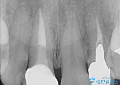 変色した保険クラウンをきれいに オールセラミッククラウンによる補綴治療の治療後