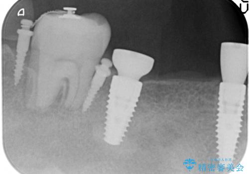 長いブリッジをインプラント補綴への変更の治療中