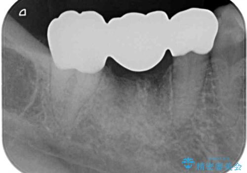 インプラントしかないと言われた 奥歯のオールセラミックブリッジの治療後