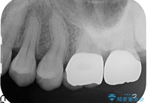 段差の気になる銀歯を改善したいの治療後