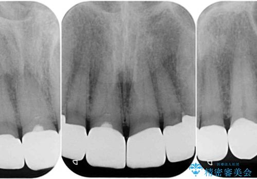 テトラサイクリン歯をオールセラミッククラウンで審美的にの治療後