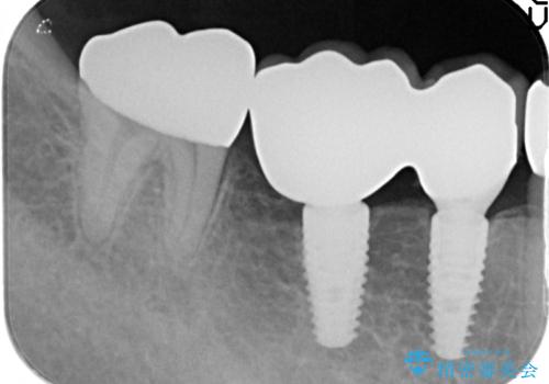 長いブリッジをインプラント補綴への変更の治療後