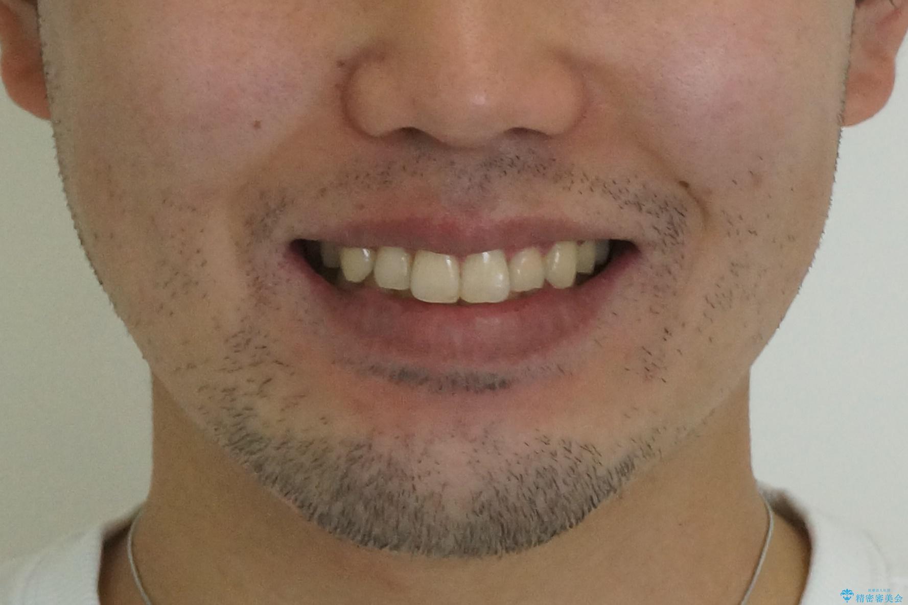 前歯のがたつき マウスピース矯正で 非抜歯で奥歯を後ろに下げる治療の治療後(顔貌)