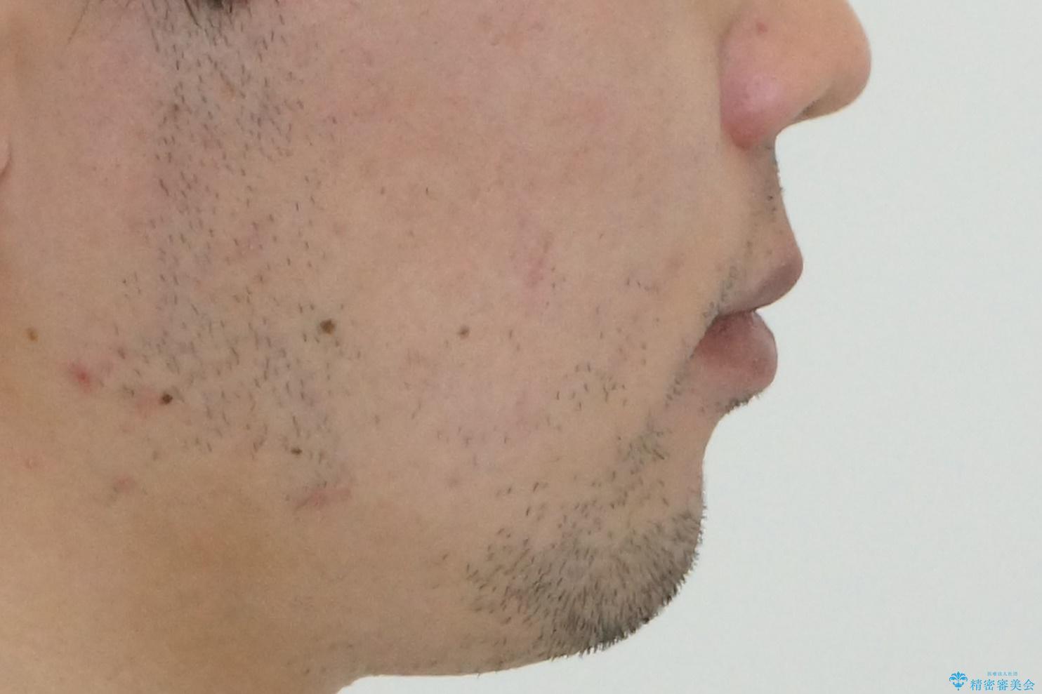 前歯のがたつき マウスピース矯正で 非抜歯で奥歯を後ろに下げる治療の治療後(顔貌)