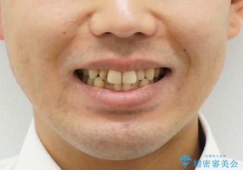前歯のがたつき　マウスピース矯正で　非抜歯で奥歯を後ろに下げる治療