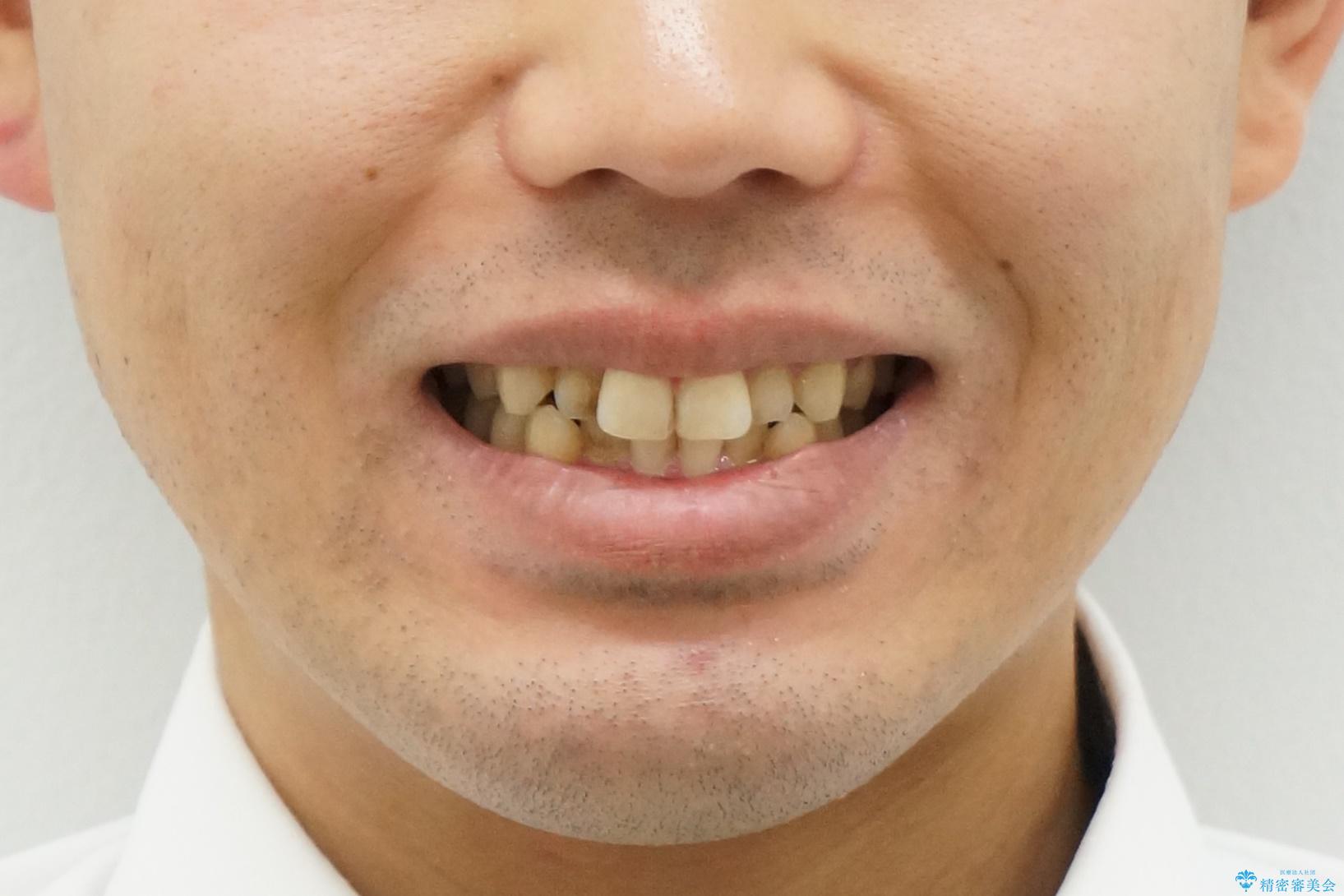 前歯のがたつき マウスピース矯正で 非抜歯で奥歯を後ろに下げる治療の治療前(顔貌)