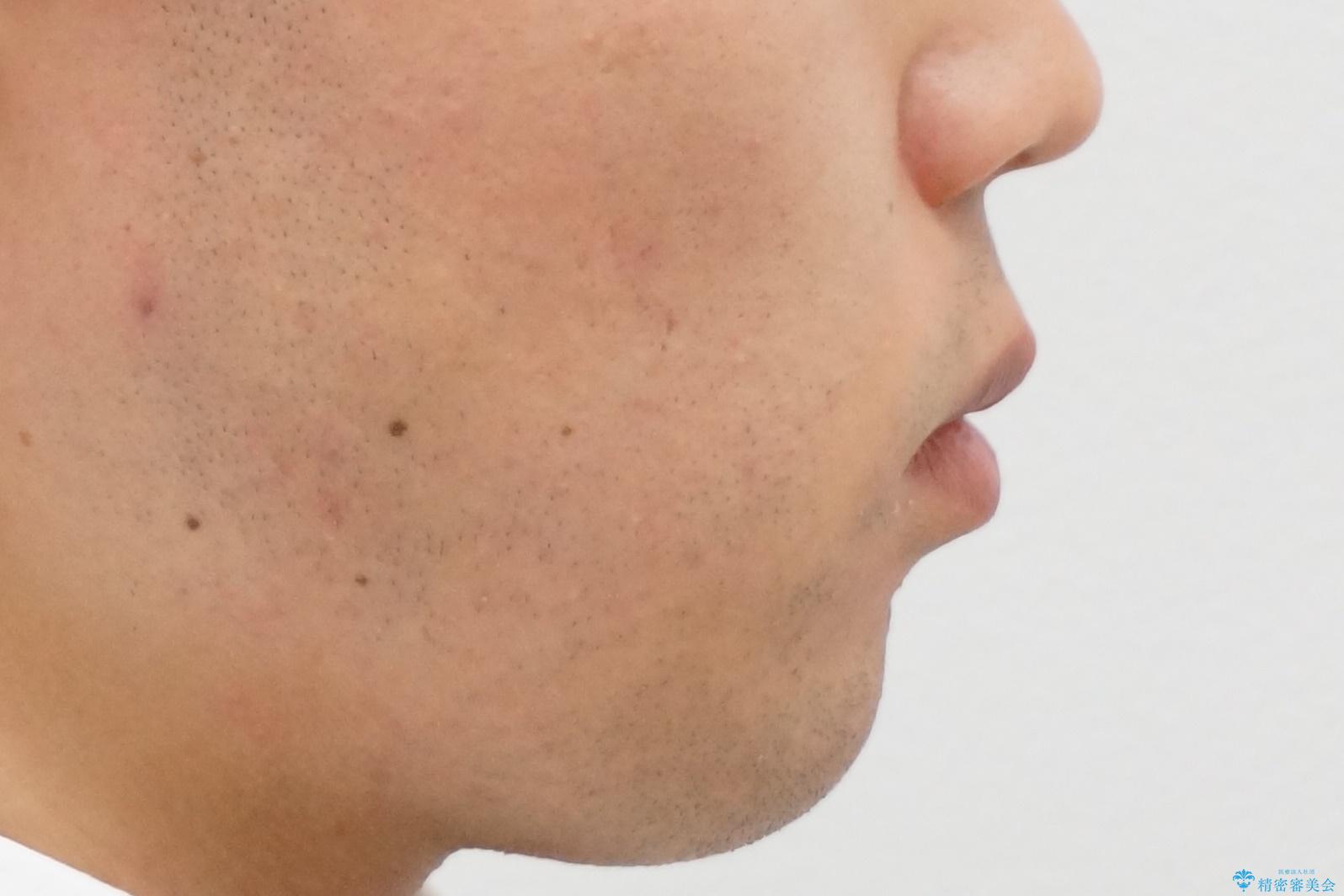 前歯のがたつき マウスピース矯正で 非抜歯で奥歯を後ろに下げる治療の治療前(顔貌)