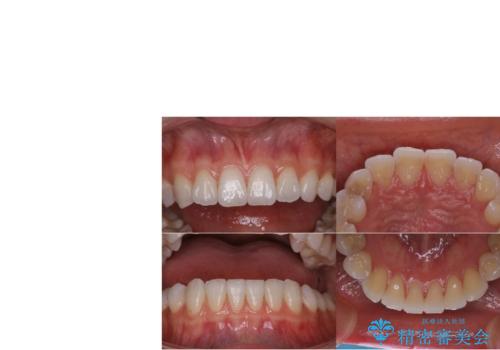 悪いところを全部治したい:適合不良の補綴物のやり直しの治療前