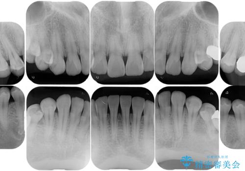 悪いところを全部治したい:適合不良の補綴物のやり直しの治療前