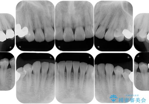 悪いところを全部治したい:適合不良の補綴物のやり直しの治療後