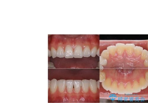 悪いところを全部治したい:適合不良の補綴物のやり直しの治療後