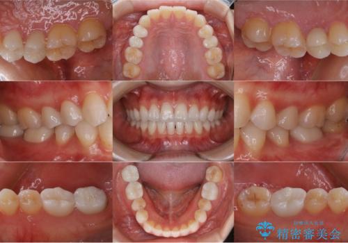 悪いところを全部治したい:適合不良の補綴物のやり直しの治療後