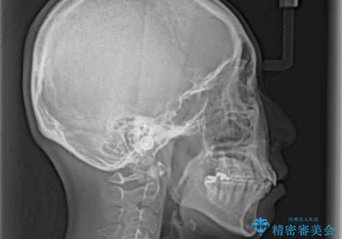 再矯正で突出した口元を引っ込める 抜歯矯正の後戻りの治療前