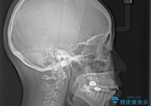 閉じにくい唇を抜歯矯正で閉じやすく 目だたないワイヤー矯正の治療前