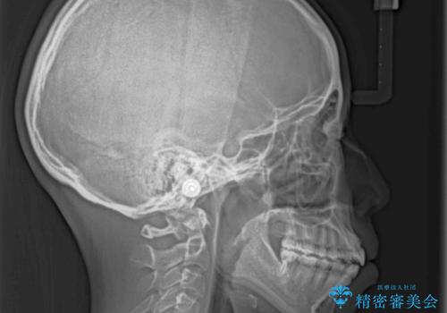目立たない装置で横顔のシルエットを改善 ハーフリンガルでの抜歯矯正の治療前