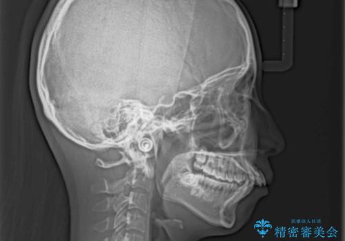 出っ歯を治したい ワイヤー装置による抜歯矯正の治療前