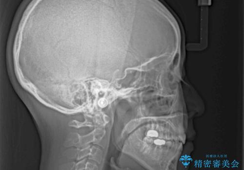 閉じにくい唇を抜歯矯正で閉じやすく 目だたないワイヤー矯正の治療後