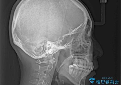 再矯正で突出した口元を引っ込める 抜歯矯正の後戻りの治療後