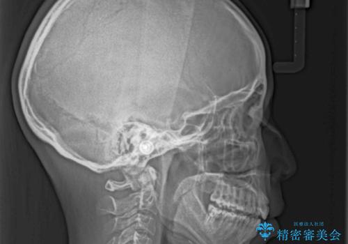 目立たない装置で横顔のシルエットを改善 ハーフリンガルでの抜歯矯正の治療後