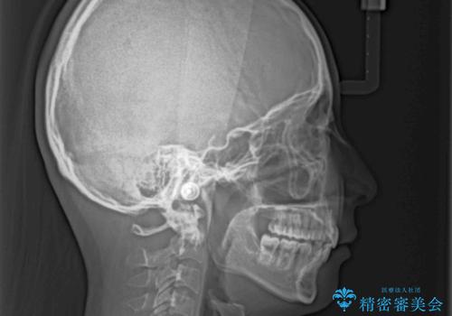 出っ歯を治したい ワイヤー装置による抜歯矯正の治療後