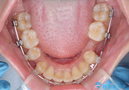 出っ歯を治したい ワイヤー装置による抜歯矯正の治療中