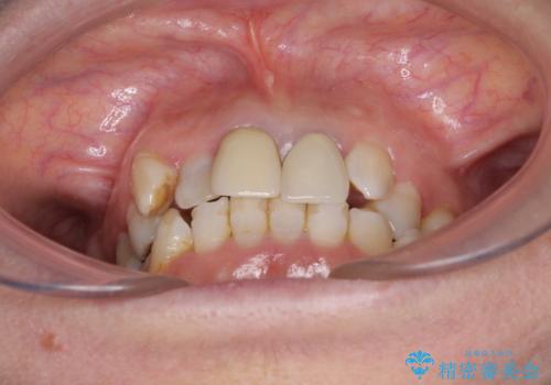 奥歯の銀歯と歯並びを改善　歯周外科治療と矯正治療を行った総合歯科診療の治療前