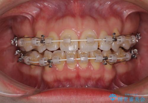 閉じにくい唇を抜歯矯正で閉じやすく 目だたないワイヤー矯正の治療中