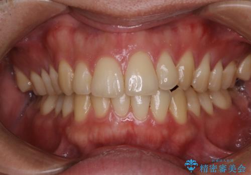 オフィスホワイトニング スペシャルコース3回の症例 治療前