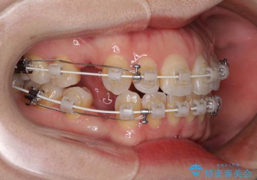 閉じにくい唇を抜歯矯正で閉じやすく 目だたないワイヤー矯正の治療中