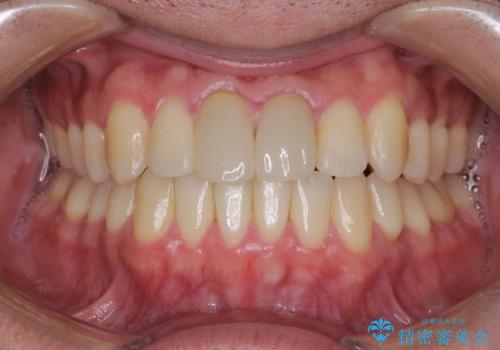 上下のがたつきをインビザラインで目立たない矯正の治療後