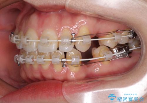 閉じにくい唇を抜歯矯正で閉じやすく 目だたないワイヤー矯正の治療中