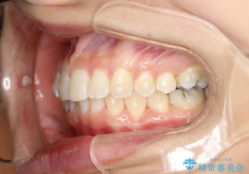 上の前歯が1本前に飛び出している　インビザラインによる目立たない矯正の治療中