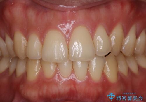 オフィスホワイトニング スペシャルコース3回の治療前
